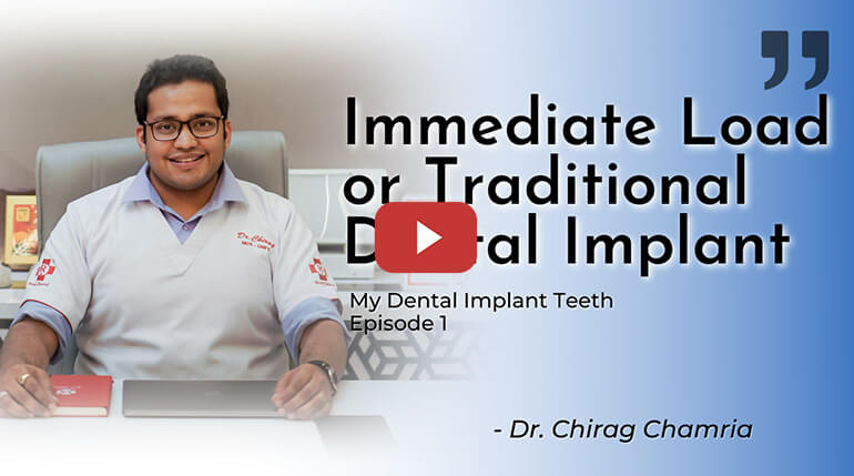 Immediate Load Implant | My Dental Implant Teeth