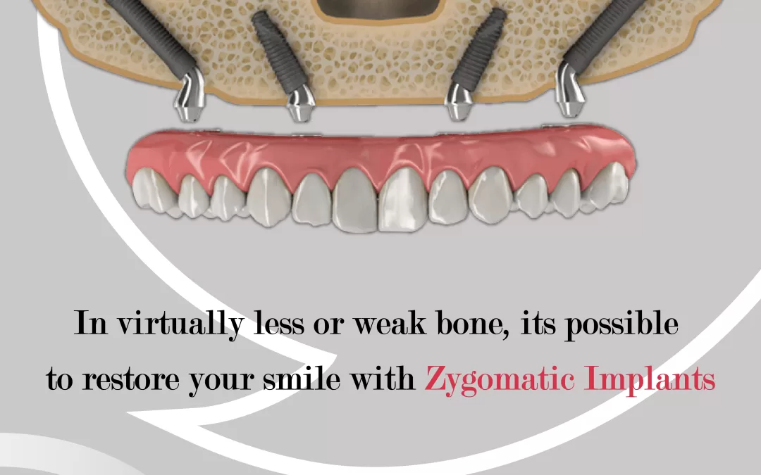 Zygomatic Dental Implant | Zygomatic Implants