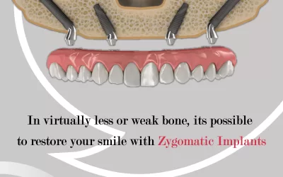 Less Bone Zygomatic Implant: Teeth for Dental Problems