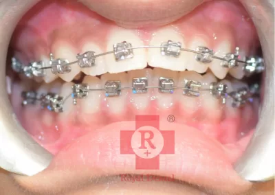 Braces and Aligners