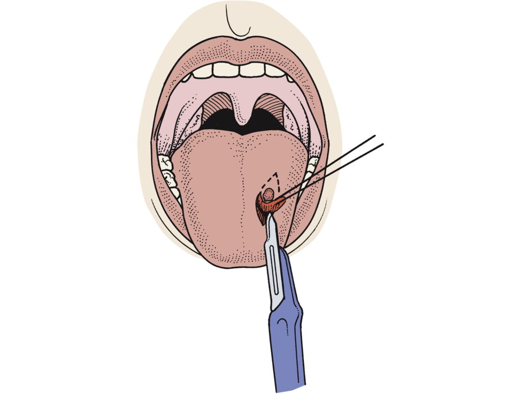 Oral biopsies for Cancer