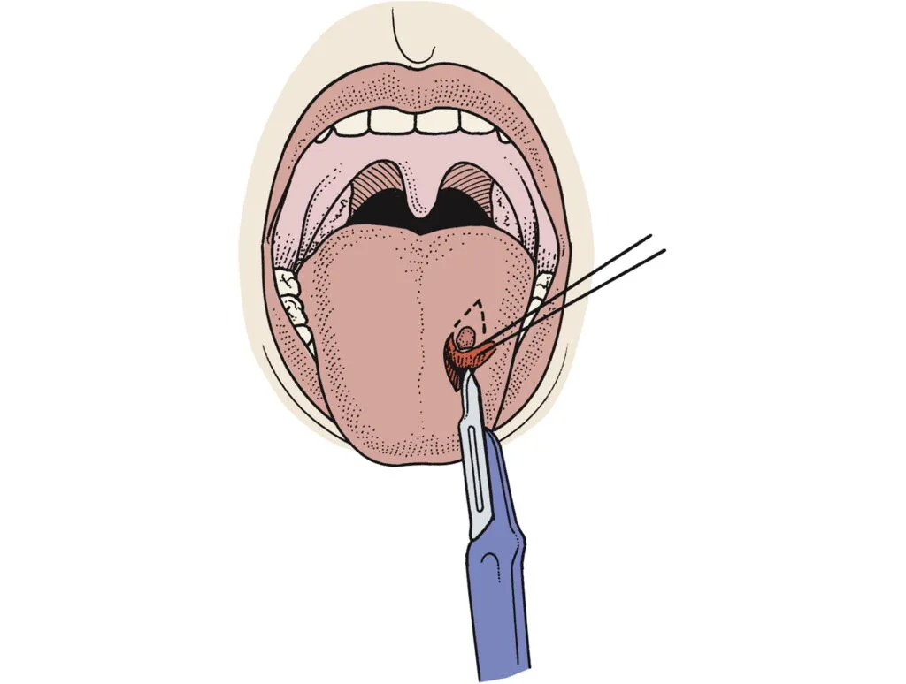 Oral biopsies for Cancer
