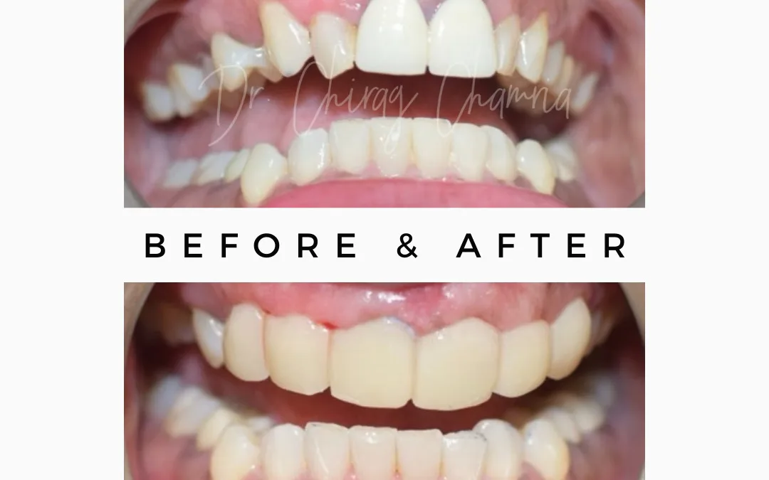 SAPTeeth Dental Crown