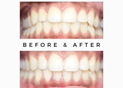 Teeth whitening before and after