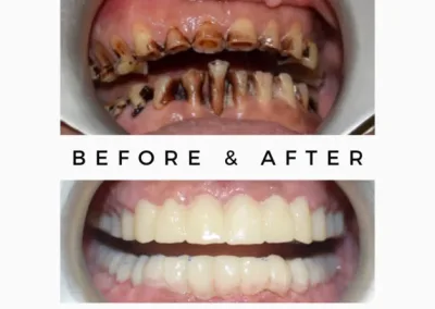 Full Mouth Smile Makeover