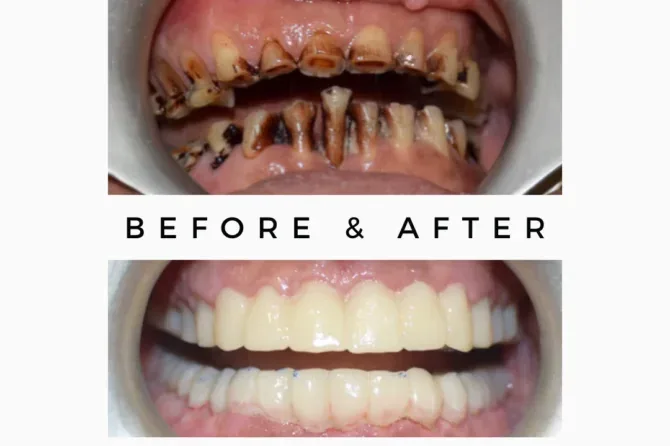 Full-Mouth-Makeover-670x446.png