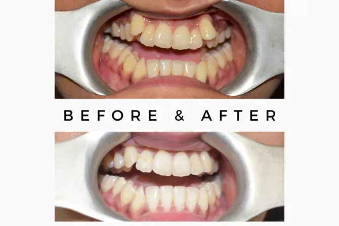Orthognathic-Jaw-Surgery Braced and Orthognathic Surgery