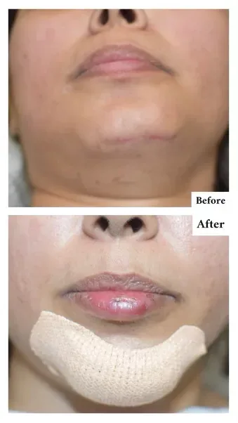 Picture-1-png Jaw Pain Treatment | TMJ Specialist in Mumbai