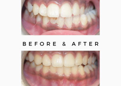 Before After Treatment