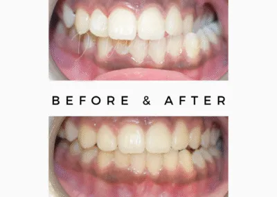 Before After Treatment