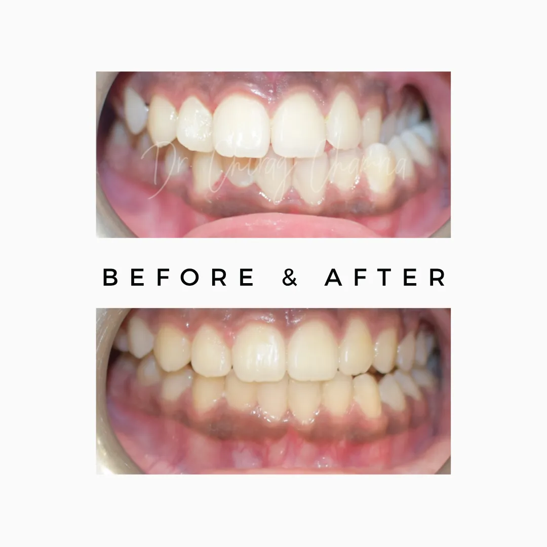 Braces Treatment to Straight Teeth Before After Treatment