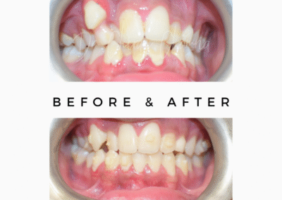 Before After Orthognathic Treatment