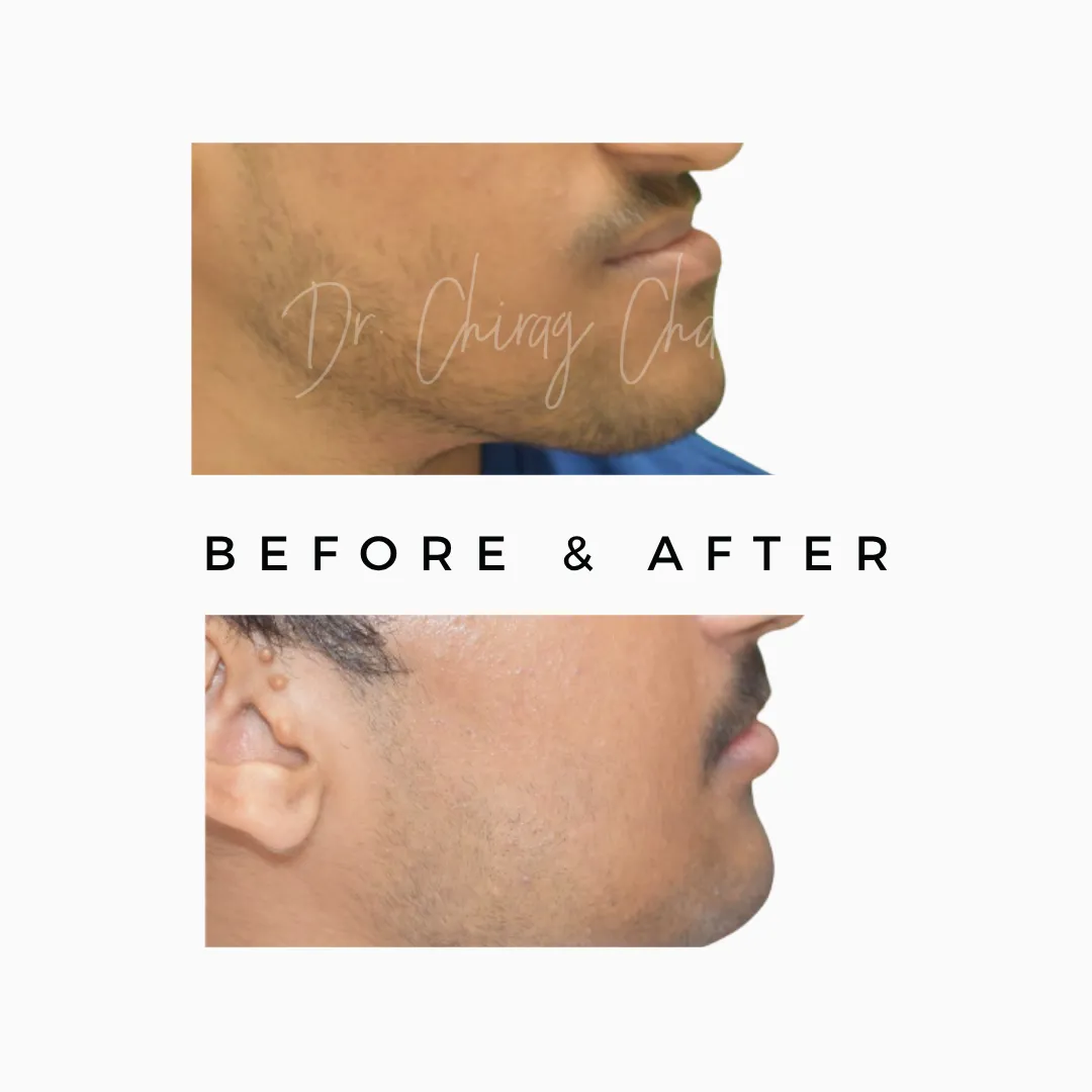 jaw surgery,orthognathic surgery,Jaw Surgery Specialist Mumbai,Orthognathic Surgery Kandivali,Corrective Jaw Surgery Mumbai,Underbite surgery Mumbai,Overbite jaw correction Kandivali,jaw alignment surgery