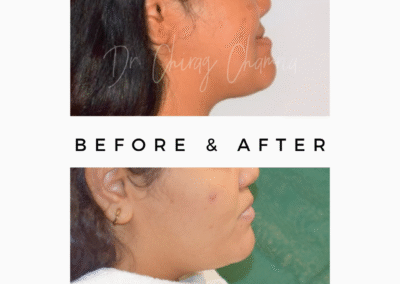 Dr Chirag Chamria | TMJ Disorders