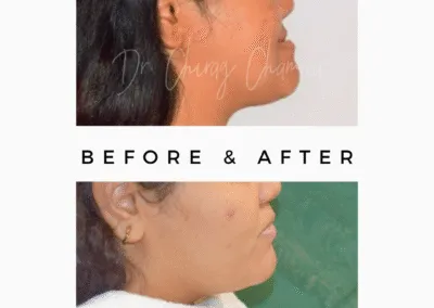 Dr Chirag Chamria | TMJ Disorders