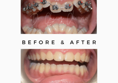 Braces and Aligners