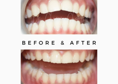 Before After Treatment