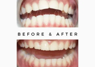 Before After Treatment