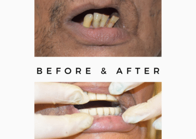 SAPTeeth Dental Crown with Implant