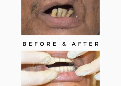 SAPTeeth Dental Crown with Implant