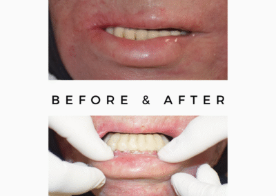 Skin cancer | Teeth replaced with implant