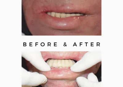 Skin cancer | Teeth replaced with implant