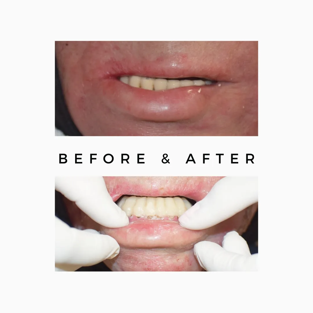 Skin cancer | Teeth replaced with implant
