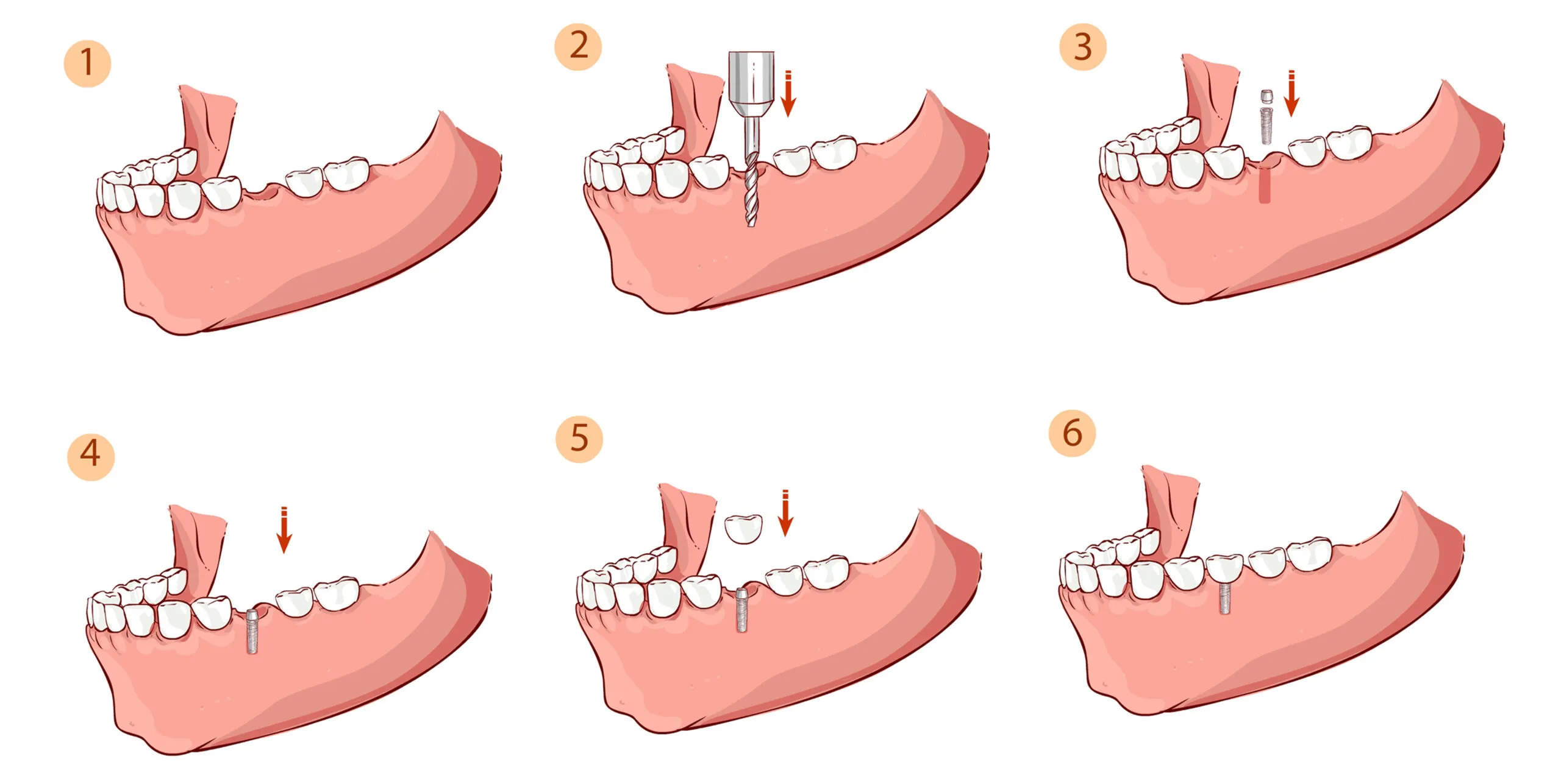 Single Stage Dental Implant Placement Technique