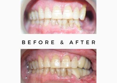 Oral Surgeon Cancer Treatment Fixed Teeth