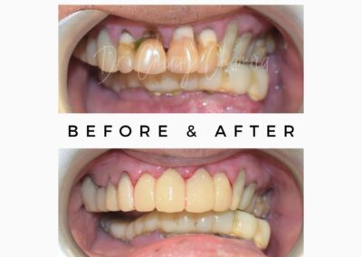 Teeth after mouth cancer