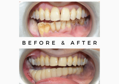 Oral Cancer and Biopsies