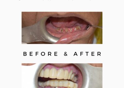 Dental X-rays showing before and after