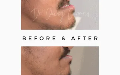 What is the treatment for jaw protrusion?