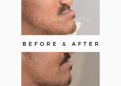 Oral Surgeon Jaw Surgery - jaw Protrusion