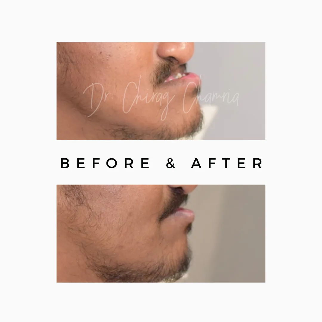 jaw surgery,orthognathic surgery,Jaw Surgery Specialist Mumbai,Orthognathic Surgery Kandivali,Corrective Jaw Surgery Mumbai,Underbite surgery Mumbai,Overbite jaw correction Kandivali,jaw alignment surgery