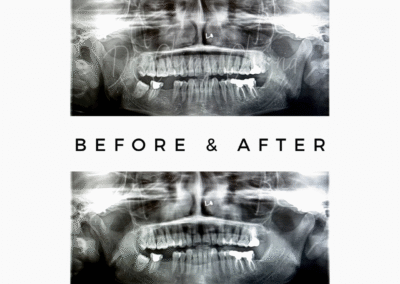 Dental X-rays showing treatment results