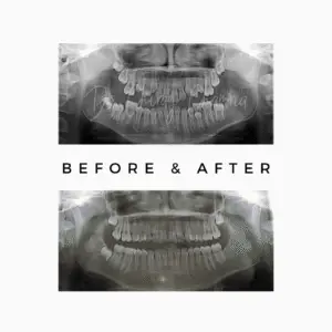 Dental X-rays showing before and after
