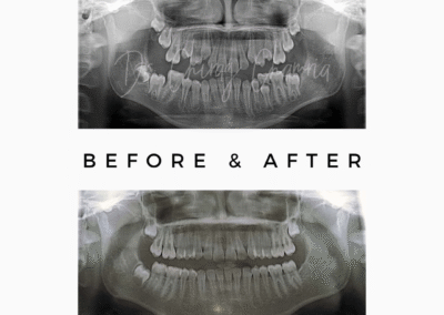 Dental X-rays showing before and after