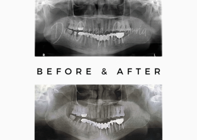 Dental X-rays showing tooth extraction results by Dr Chirag Chamria