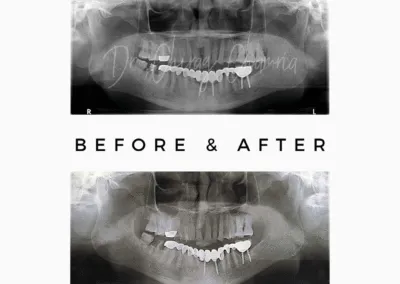 Dental X-rays showing tooth extraction results by Dr Chirag Chamria