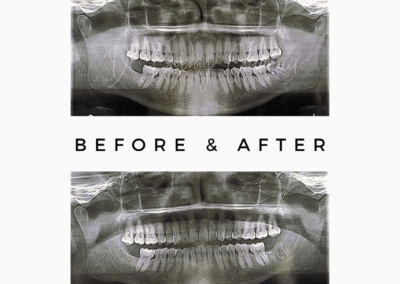 X-ray comparison before and after