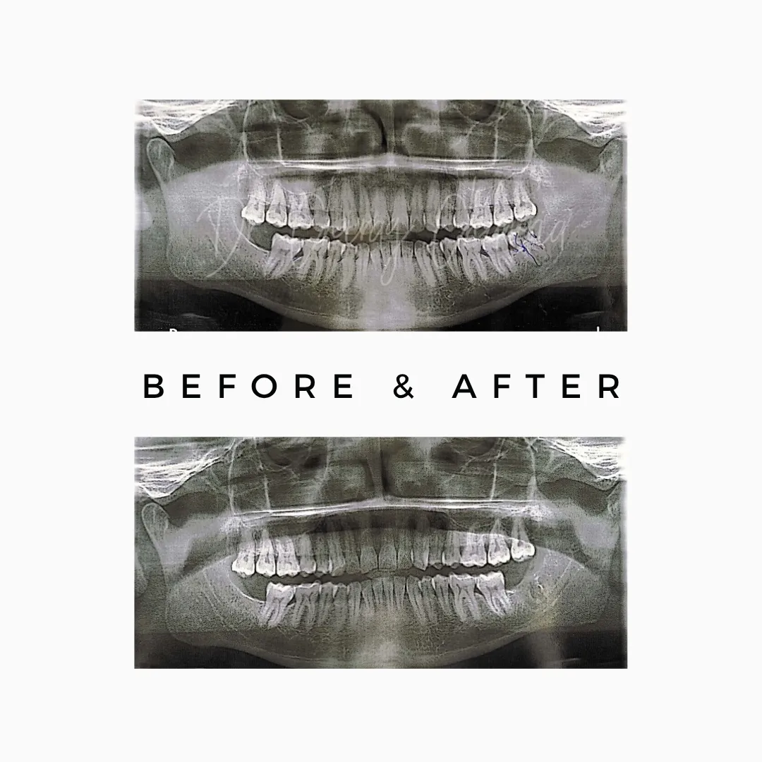Wisdom Tooth Extraction X-ray comparison before and after