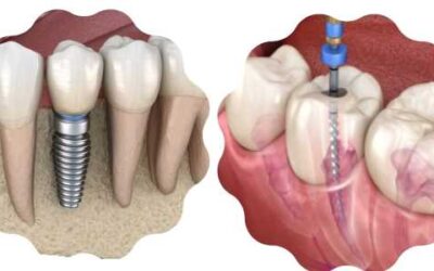 Managing Failed Implants and Root Canal