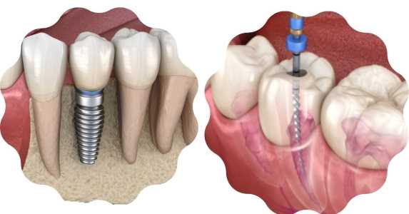 Managing Failed Implants and Root Canal