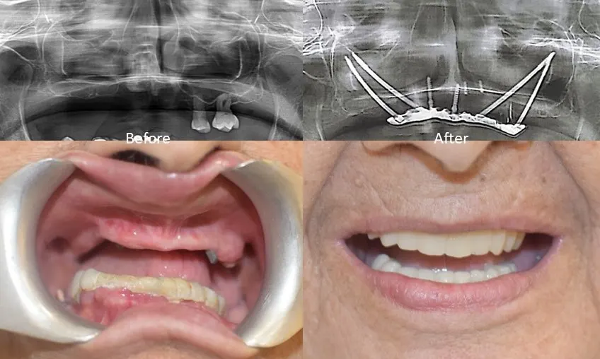 zygomatic dental implants,Zygomatic Implants Mumbai,Zygomatic Implant Specialist,Zygoma Implant Surgeon Mumbai,No bone dental implants Mumbai,Dental implants without bone graft Mumbai,zygoma bone,zygomatic bone,bone loss