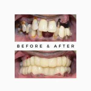 Full Mouth Dental Implant Surgeon