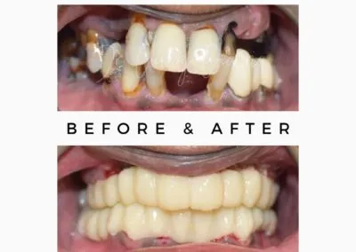 Full Mouth Dental Implant Surgeon
