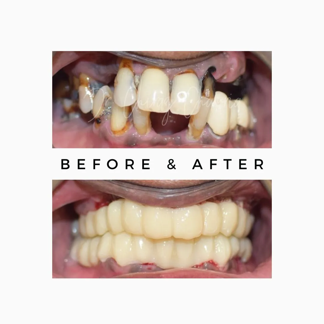Full Mouth Implant,full mouth Implants Mumbai,Implant Specialist Kandivali,Implant Surgeon Mumbai,Full mouth rehabilitation,full mouth makeover