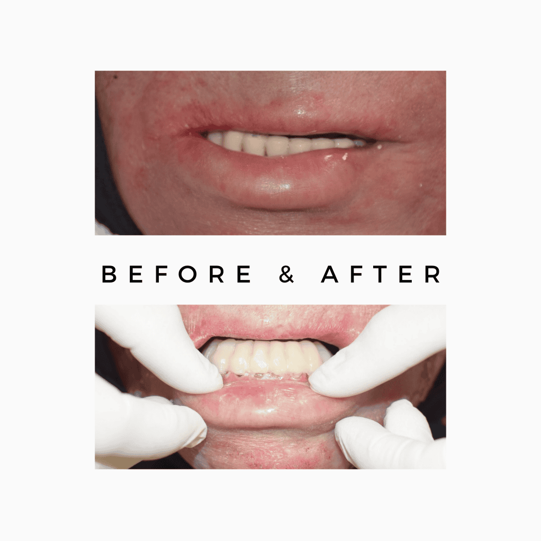 oral cancer,cancer treatment,Oral Cancer Surgeon Mumbai,Jaw Reconstruction After Cancer Mumbai,Cancer Rehabilitation Dentist Kandivali,Teeth after cancer surgery Mumbai,CAJTeeth,oral cancer teeth