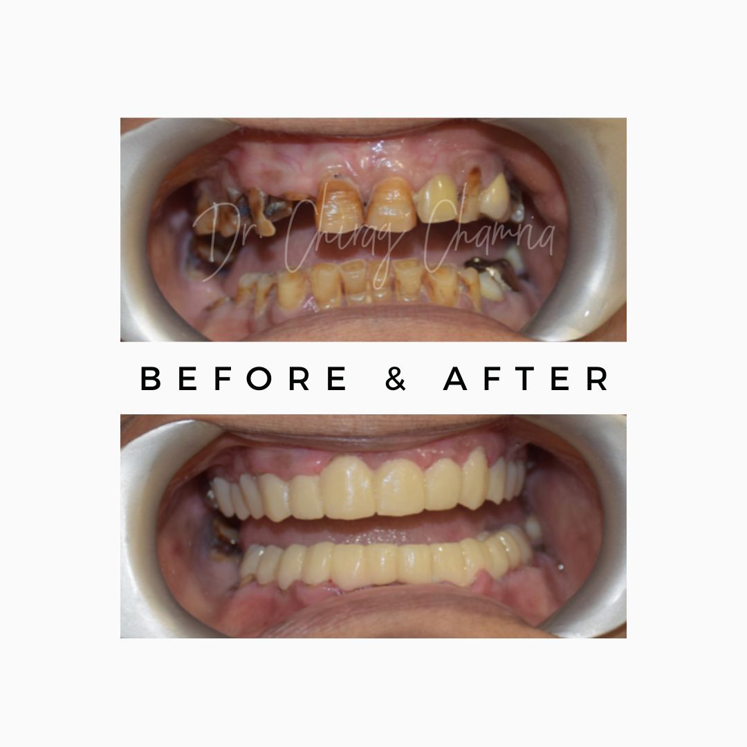 Full Mouth Implant,full mouth Implants Mumbai,Implant Specialist Kandivali,Implant Surgeon Mumbai,Full mouth rehabilitation,full mouth makeover